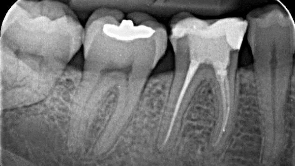 Wurzelkanalbehandlung durch Dr. Ritter M.Sc. (Endodontologie)