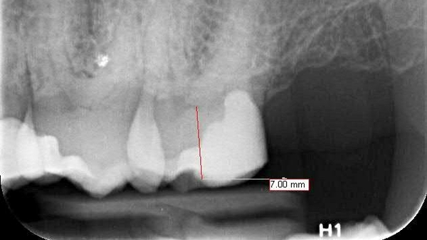 Endodontische Behandlung durch Dr. Ritter M.Sc. (Endodontologie)